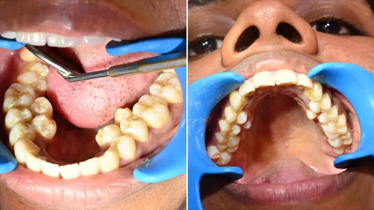 This Indian woman has so many teeth in her mouth that she registered her name in the Guinness World Records.