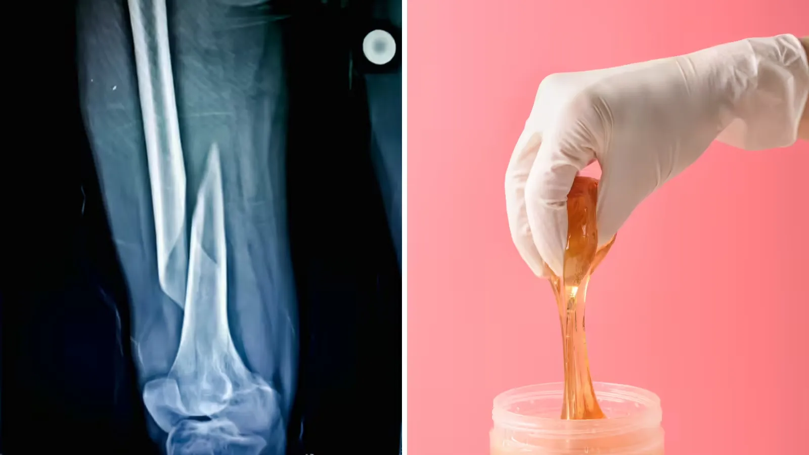 अब सिर्फ 3 मिनट में जुड़ेगी हड्डी!, वैज्ञानिकों ने बना दिया हड्डी जोड़ने वाली गोंद-Bone Glue bone fracture