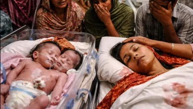 Aligarh Conjoined Twins Case